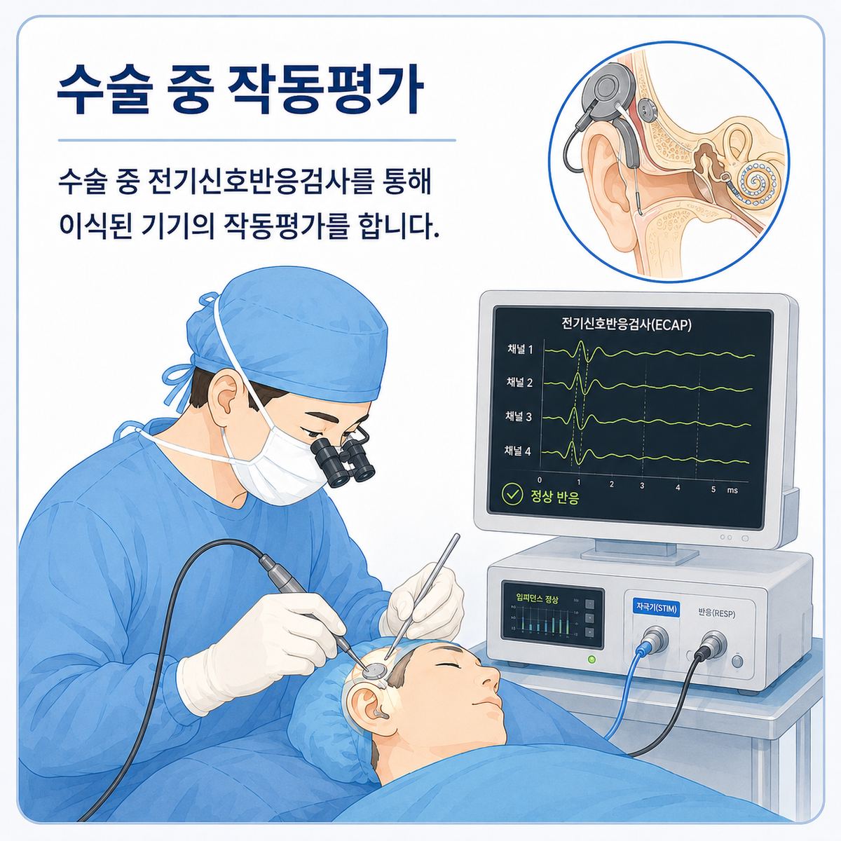 수술 중 작동평가 - 전기신호반응검사(ECAP)를 통해 이식된 기기의 작동평가를 합니다.